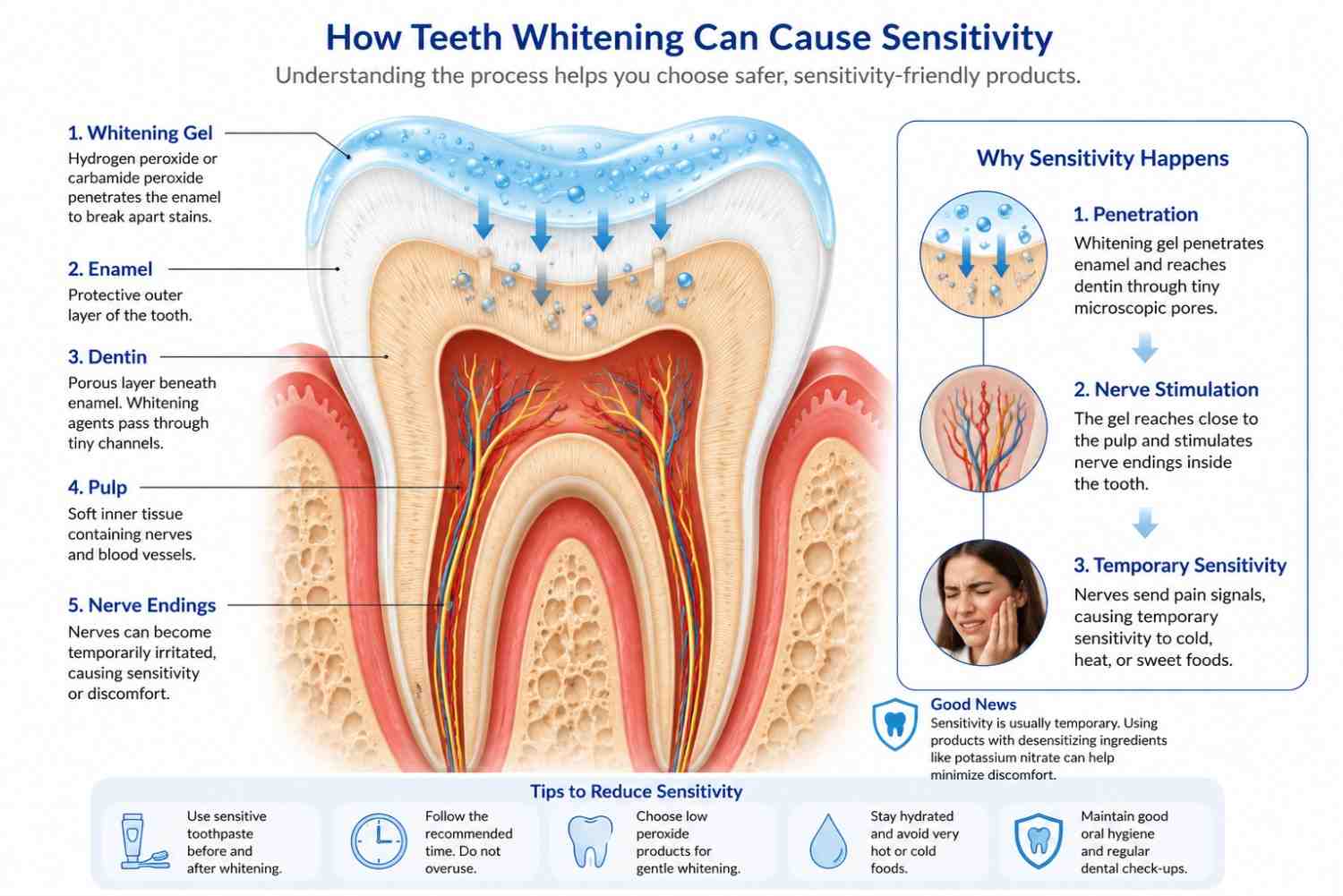 Illustration showing how whitening gel reaches tooth enamel and causes temporary sensitivity