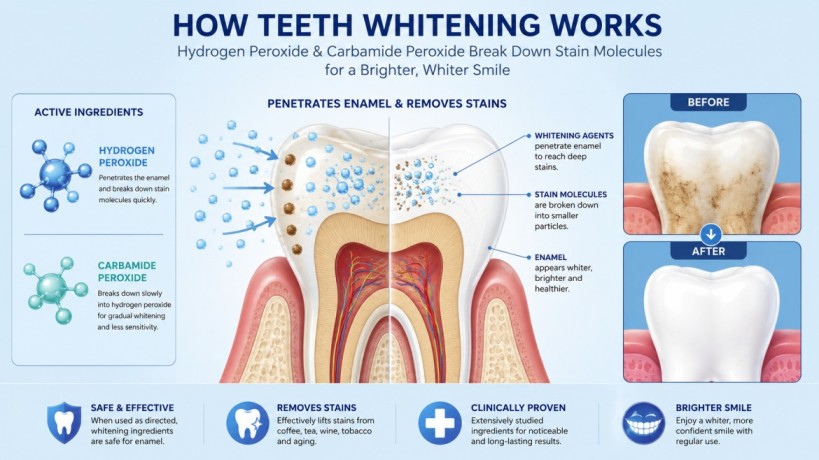 How peroxide teeth whitening products remove stains from enamel