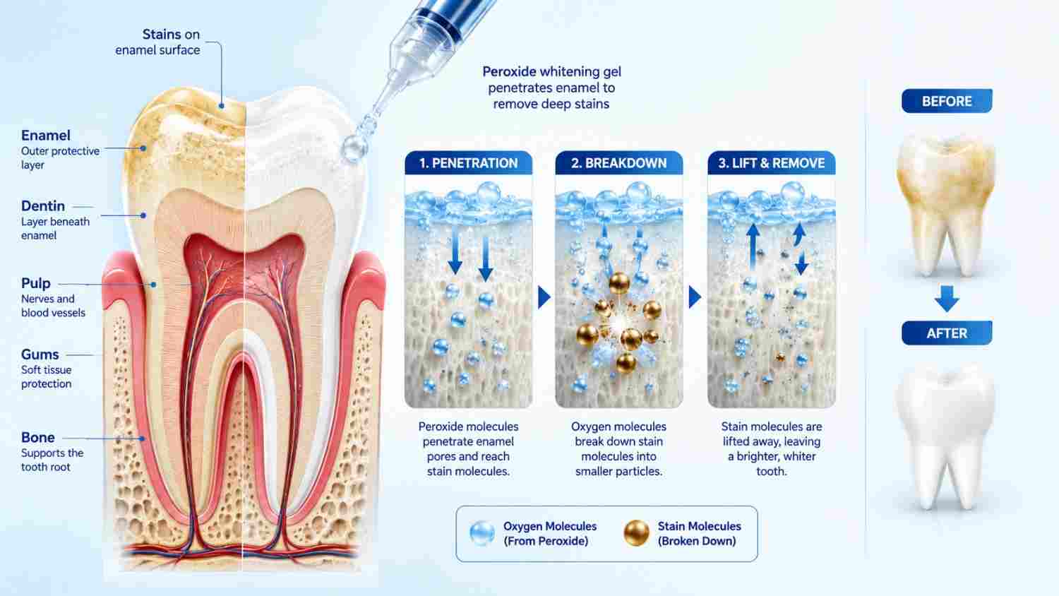 Illustration showing how bleaching gel removes stains from tooth enamel.
